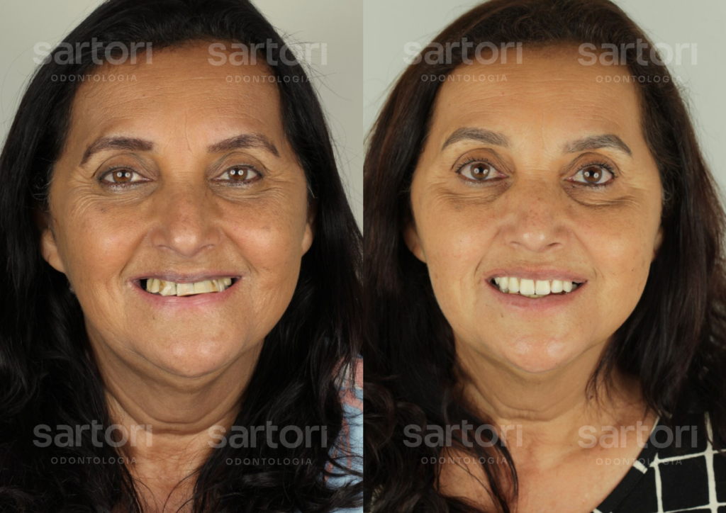 13 - ANTES E DEPOIS - 18.09