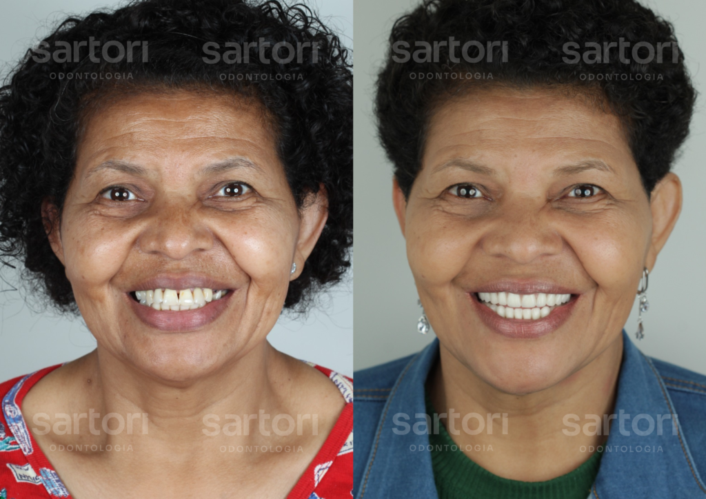 14 - ANTES E DEPOIS - 18.09