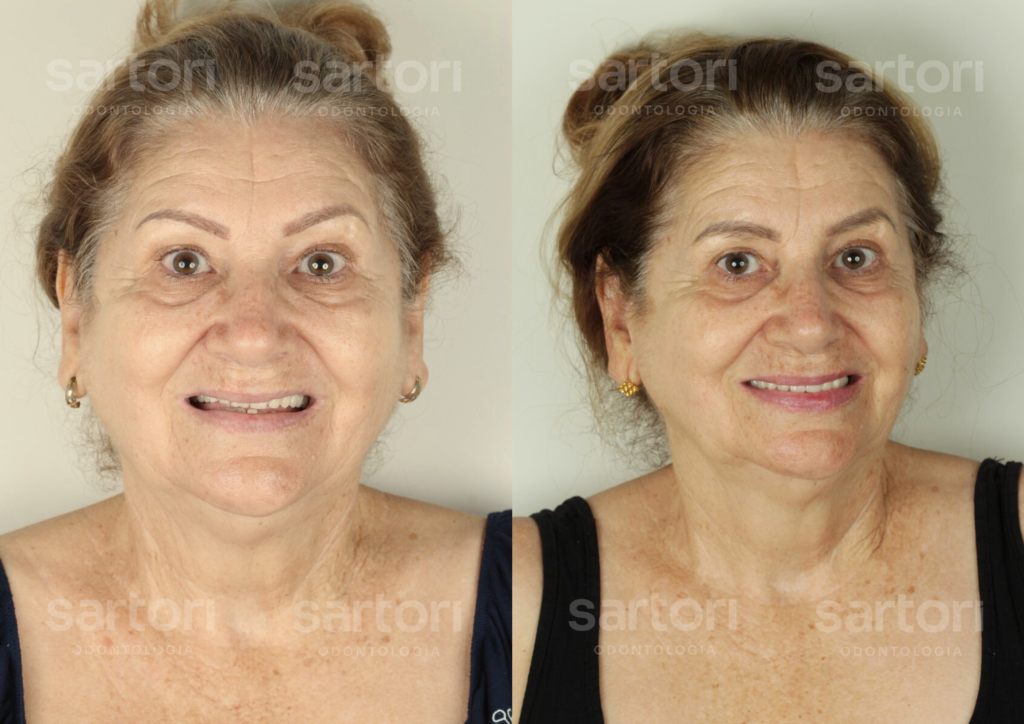 15 - ANTES E DEPOIS - 18.09