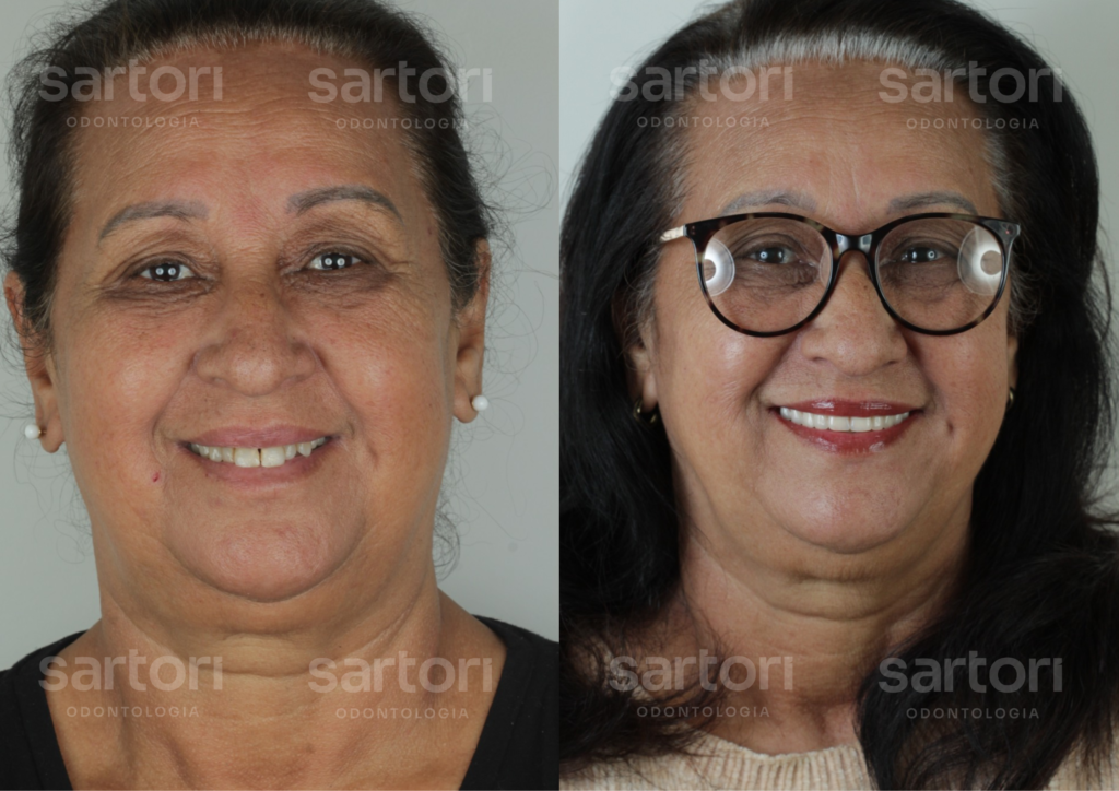 17 - ANTES E DEPOIS - 18.09